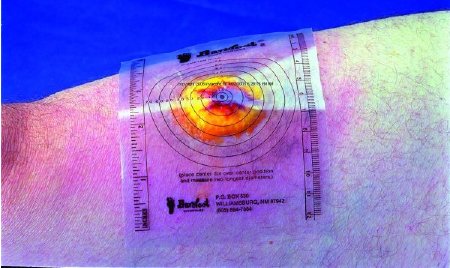 Trademark Medical  B250 Measuring Guide 3-3/4 X 5-1/2 Inch Plastic